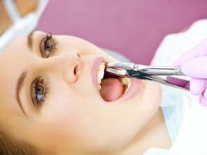 Картинки по запросу удаление зубов