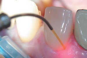 Лазерная стоматология.jpg