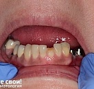 Востановление и лечение зубов