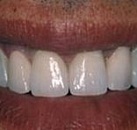 Лечение разрушенного зуба цена thumbnail