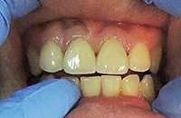 Востановление и лечение зубов thumbnail