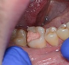 Лечение зуба без врача thumbnail