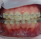 Лечение зубов исправление прикуса thumbnail