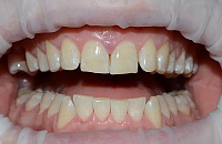 Лечение зубов аир флоу thumbnail