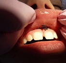 Быстрое лечение зубов стоматология