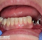 Лечение разрушенного зуба цена