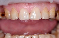 Стоимость лечения зуба с пломбированием каналов