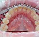 Ультразвуковое лечение зубов цена