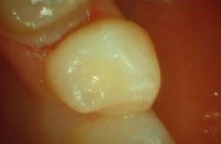Зубы лечение без стоматологии