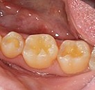 Лечение зуба на замете