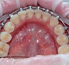 Лечение налета на зубах цена thumbnail