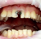 Стоматология лечение зуба с пломбой thumbnail