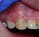 Востановление и лечение зубов
