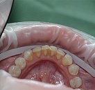 Профессиональная чистка зубов лечение
