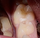 Стома лечение зубов детям