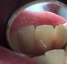 Лечение зубов у детей недорогой и хороший