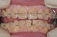 Лечение налета на зубах цена