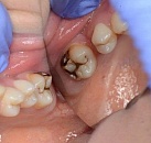 Лечение зуба в рос