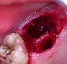Стоматология лечение и удаление зуба мудрости