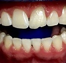 Лечение всех зубов zoom