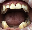 Лечение зубов современными материалами thumbnail