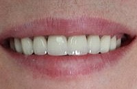 Восстановление и лечение зубов