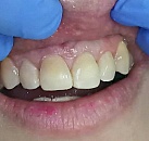Полный курс лечения зубов thumbnail