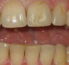 Лечение и отбеливание зубов цены thumbnail
