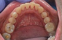 Профессиональная чистка зубов лечение