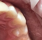 Стома лечение зубов детям thumbnail