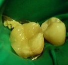 Стоимость лечения зуба с пломбированием каналов