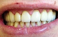 Восстановление и лечение зубов
