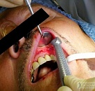 Киста зуба лечение в петербурге