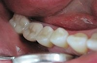 Раскрошился зуб цена лечения thumbnail