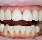 Пломба для зубов без лечения