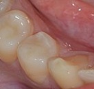 Полный курс лечения зубов