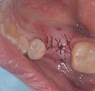 Лечение зубов имплантация зубов цена