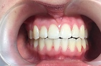 Установка брекетов и лечение зубов