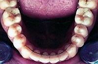 Прикус зубов неправильный лечение прайс thumbnail