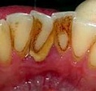 Лечение зубов фтором цена thumbnail