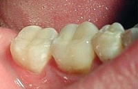 Детский стоматолог лечение зубов
