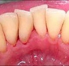 Лечение зубов фтором цена