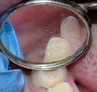 Стоматология лечение зубов детям thumbnail