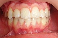 Прикус зубов неправильный лечение прайс