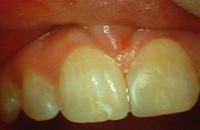 Лечение зубов в растущей