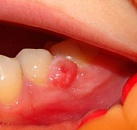 Лечение кисты зуба в клиниках петербурга