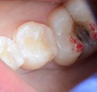 Лечение зуба на замете thumbnail