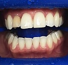Лечение всех зубов zoom
