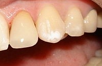 Лечение разрушенного зуба цена