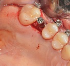 Лечение зубов имплантация зубов цена